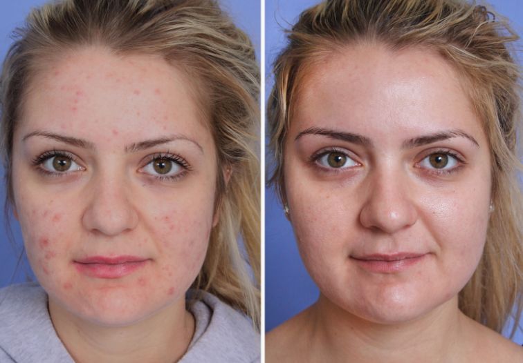 Before &After
